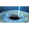 Logo Gemeinschaftspraxis Accuratis Augenlaser GbR Dres. R&uuml;diger Schmid und Wolfgang Lenz