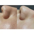 Hydrafacial Hamburg