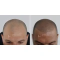 Haarpigmentierung K&ouml;ln | OpticHair K&ouml;ln