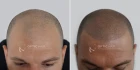 Logo Haarpigmentierung Köln | OpticHair