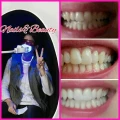 Zahnbleaching Aktion 79&euro;