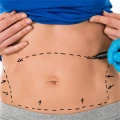 Plastische Chirurgie Heilbronn - Andreas M&ouml;ller Aesthetic Medicine Flein